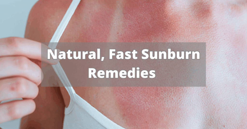 Best Natural Remedies for Sunburn